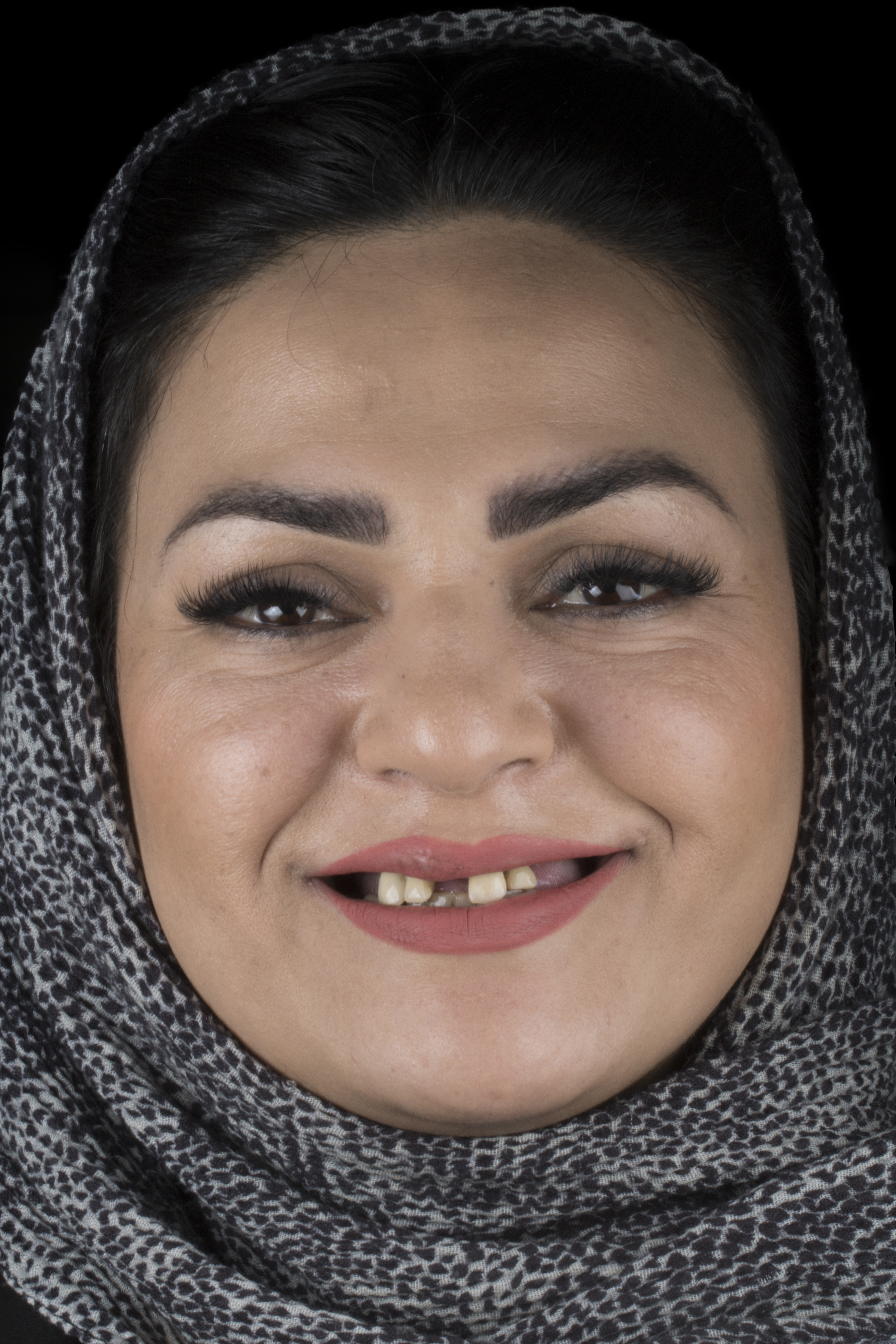 قبل · دندان گم‌شده